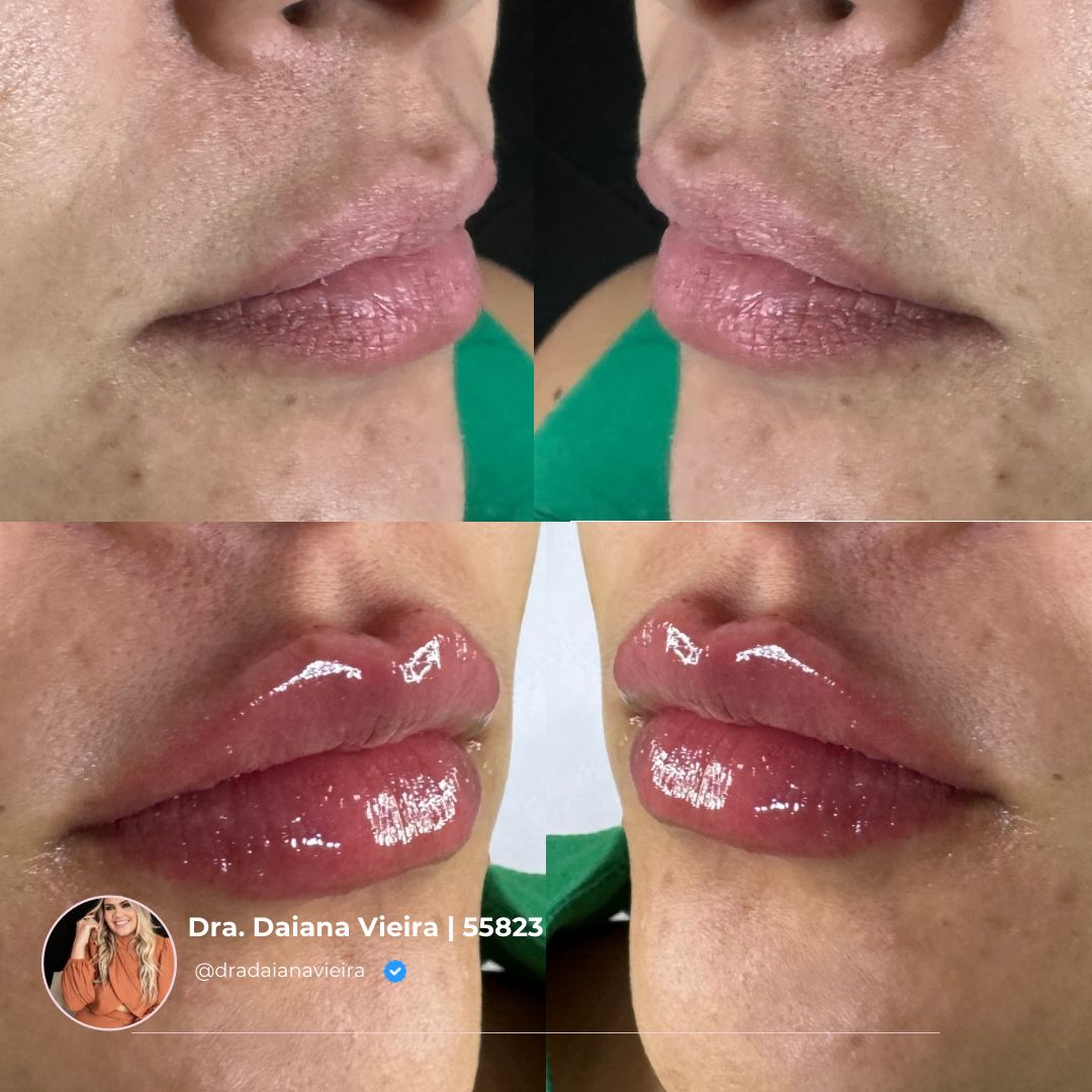 Antes e Depois - Tratamento de acne e cicatrizes