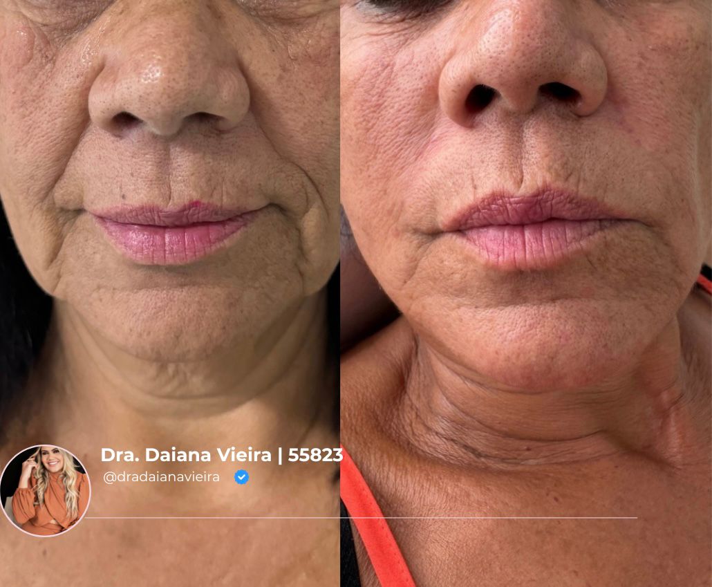 Antes e Depois - Rugas periorais e flacidez