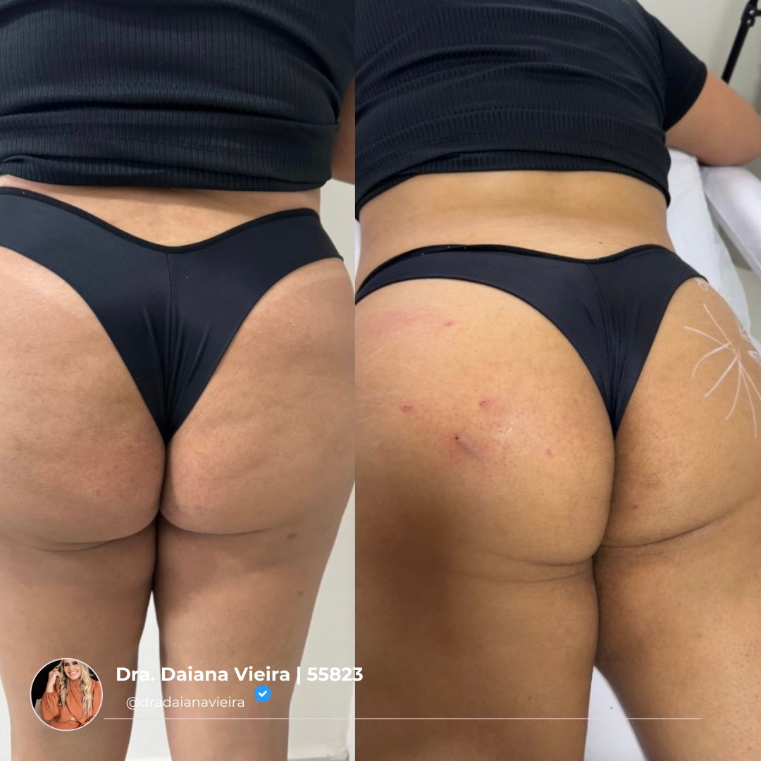 Antes e Depois - Contorno corporal e celulite