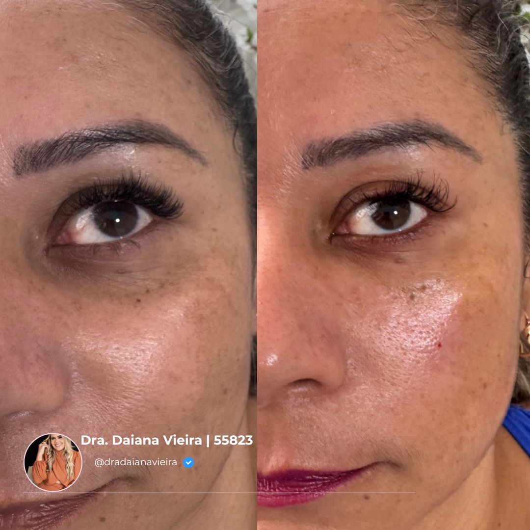 Antes e Depois - Olheiras e manchas