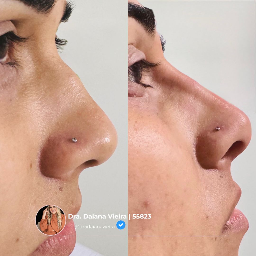 Antes e Depois - Lifting facial com fios