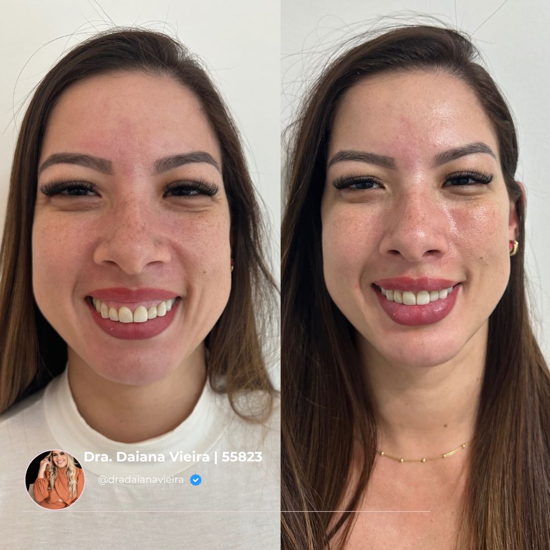 Antes e Depois - Harmonização facial completa