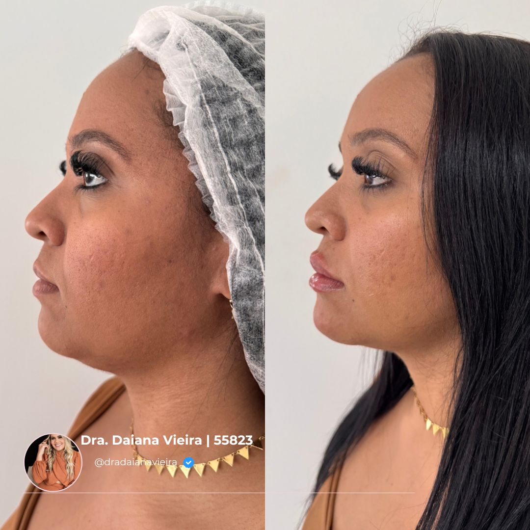 Antes e Depois - Rejuvenescimento de mãos